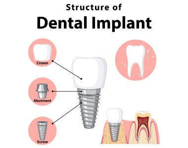 Dental Implants Cincinnati